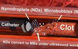 血栓治疗新突破：“超声钻”和纳米液滴可分解血块