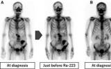 专家推荐 | 223Ra对去势抵抗性前列腺癌骨转移疗效的核医学评估研究进展