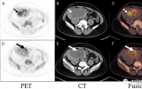 FDG PET/CT发现一移植肾内滑膜肉瘤