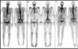 核医学骨扫描研究确定心脏淀粉样变性的患病率和预后