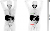 用于前列腺癌的PET示踪剂在III期试验中表现良好